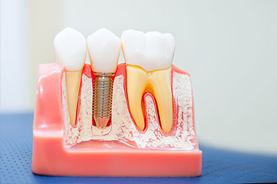 James G. Agnew, DMD | Dental Fillings, Cosmetic Dentistry and Periodontal Treatment