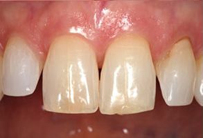 James G. Agnew, DMD | Periodontal Treatment, Inlays  amp  Onlays and Crowns